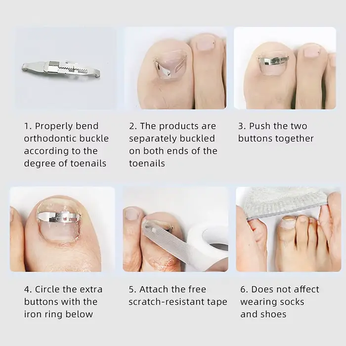 Outil professionnel de traitement des ongles incarnés