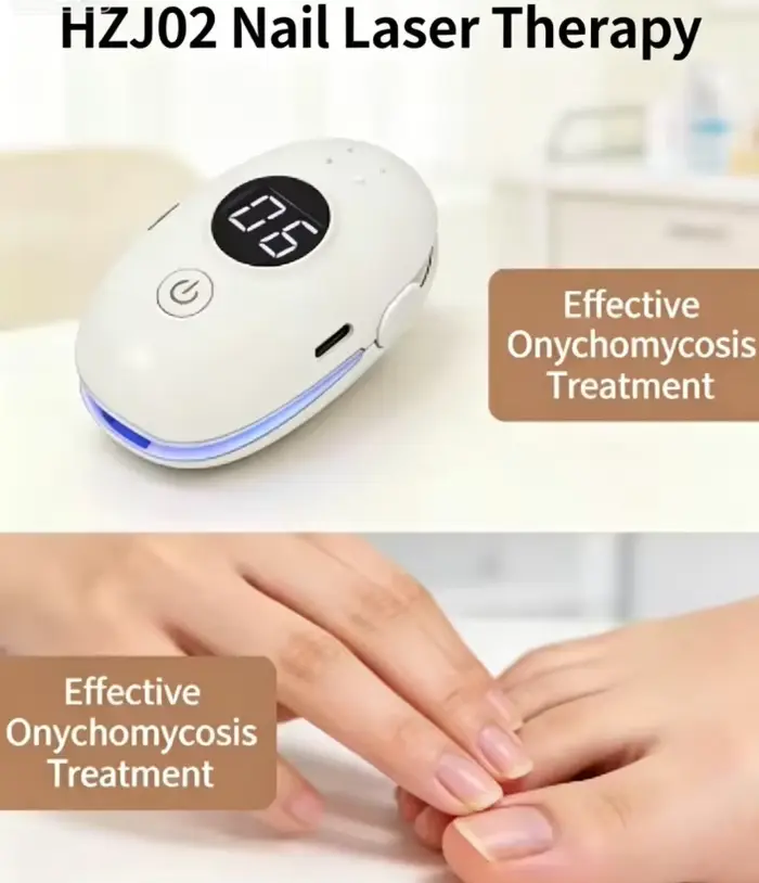 Appareil de réparation des ongles pour le traitement de l'onychomycose – Technologie laser de pointe