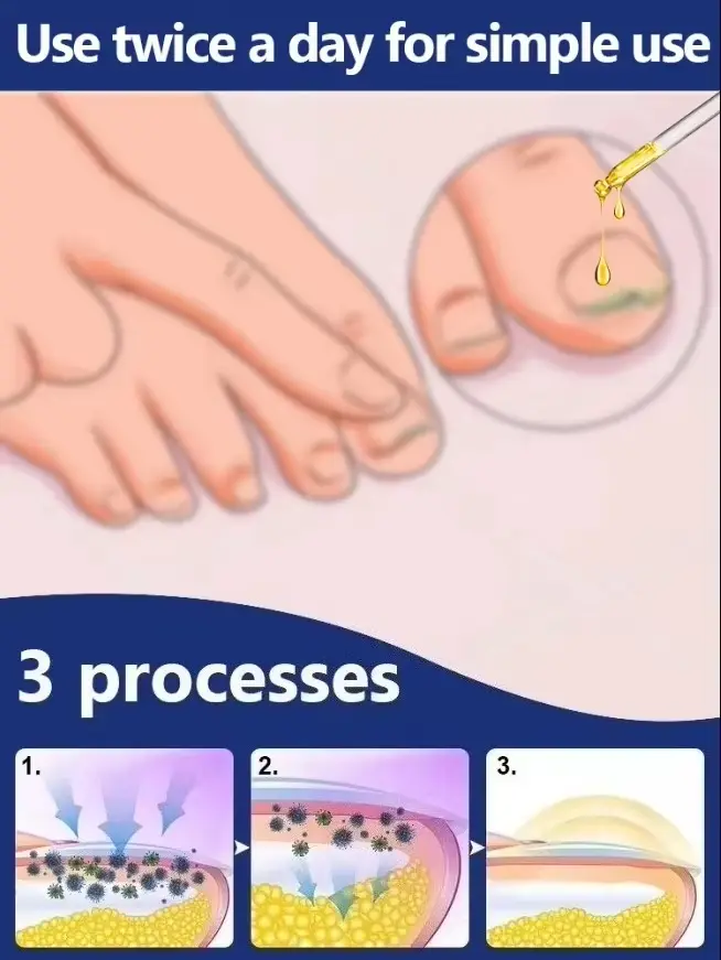 Élimine rapidement les champignons et restaurer les ongles sains 9