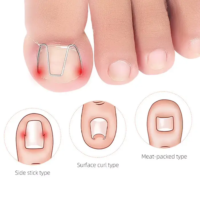 Outil de Correction des ongles incarnés, orthèse des ongles, Clip Paronychia
