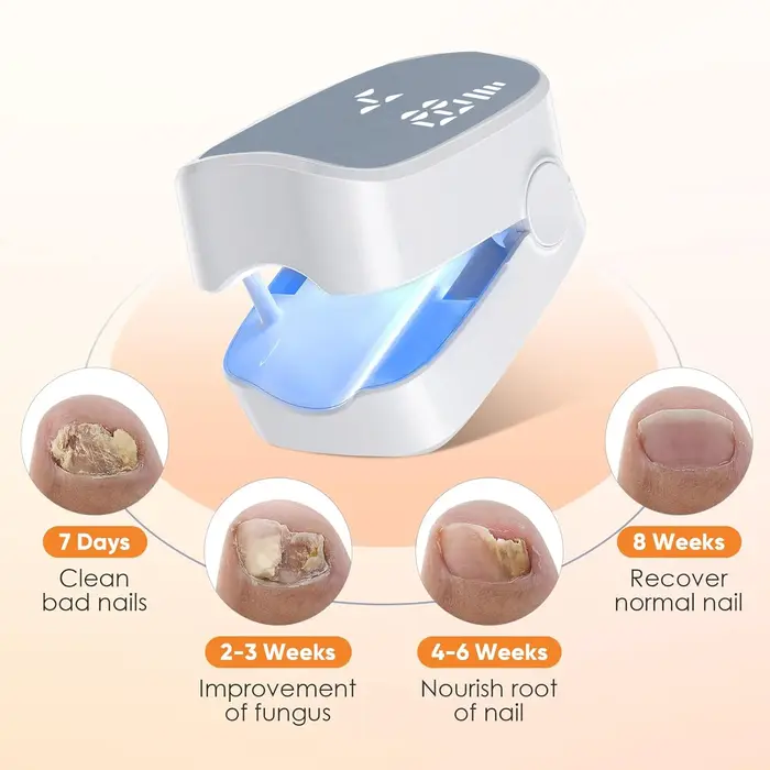 Outils de traitement des champignons des ongles à infrarouge, élimine les champignons des ongles des orteils, Infection fongique des ongles, Anti-équipement efficace, Machine Rechargeable