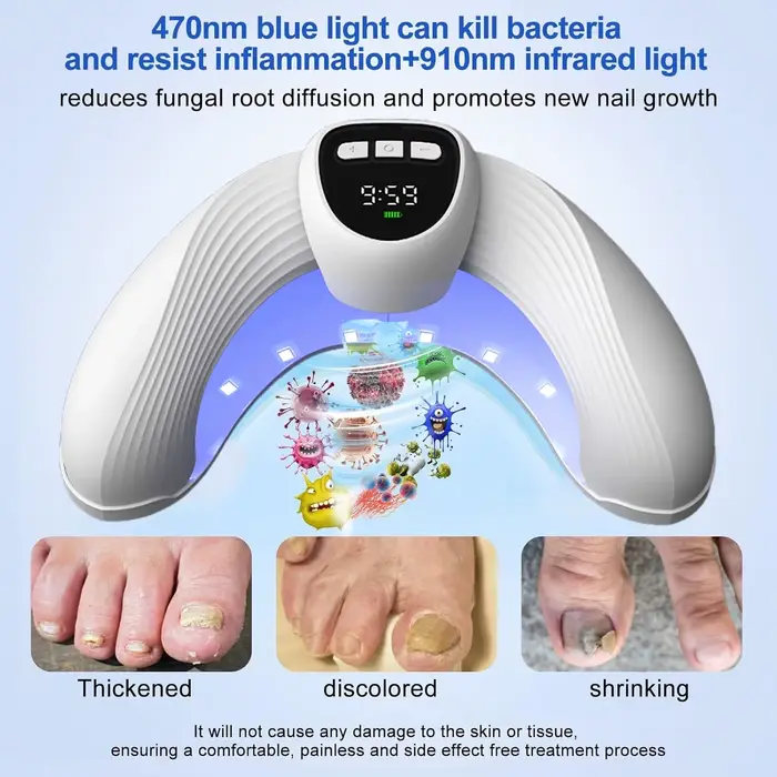 Dispositif de traitement au Laser pour champignons des ongles