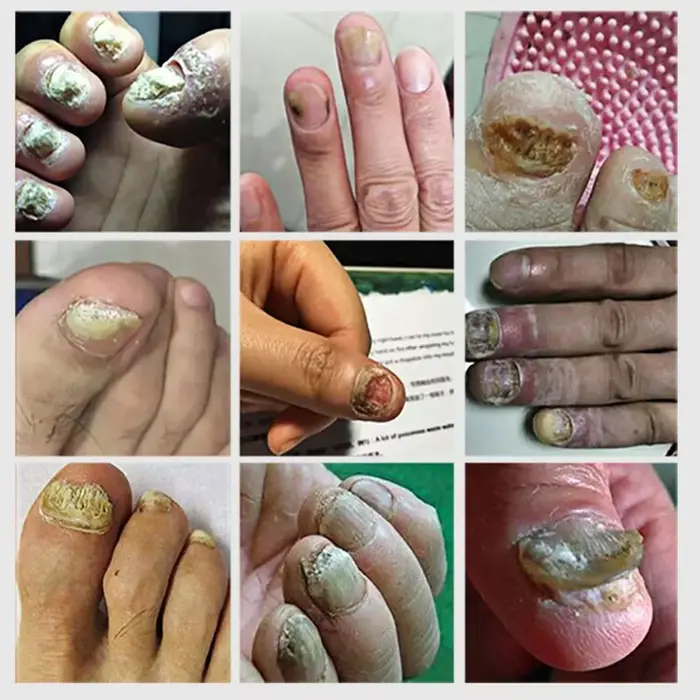 Dispositif de traitement au Laser pour champignons des ongles