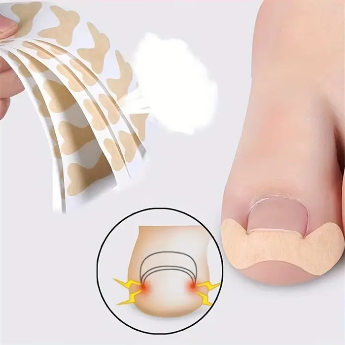 Patch Ortho pour Ongles Incarnés