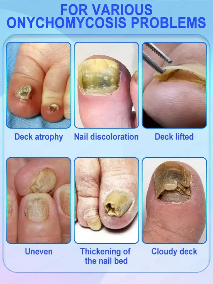 Dites au revoir l'onychomycose et restaurer les ongles normaux