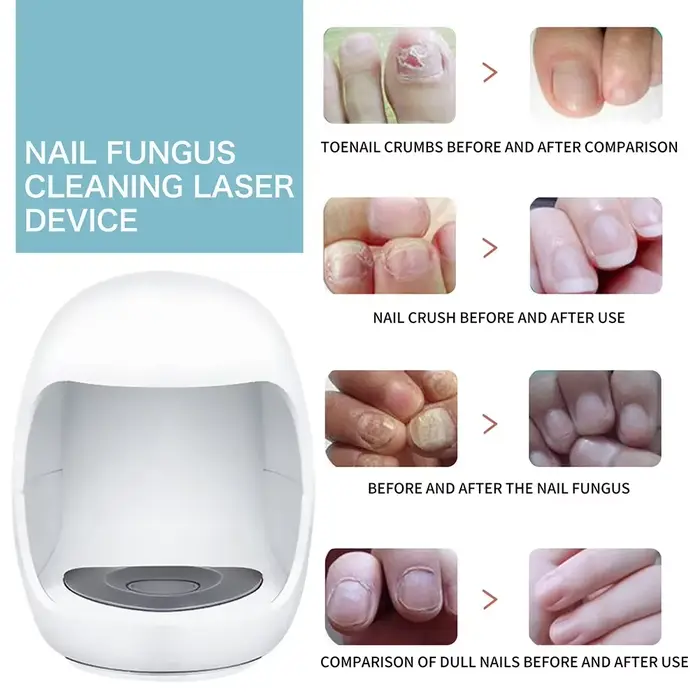Appareil de traitement au laser pour champignon des ongles