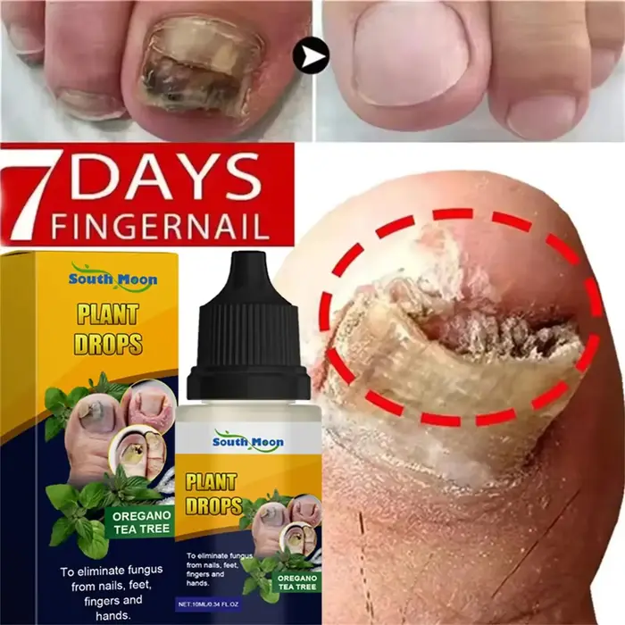 7 jours traitements fongiques des ongles sérum liquide Anti-Infection onychomycose Paronychia soin d
