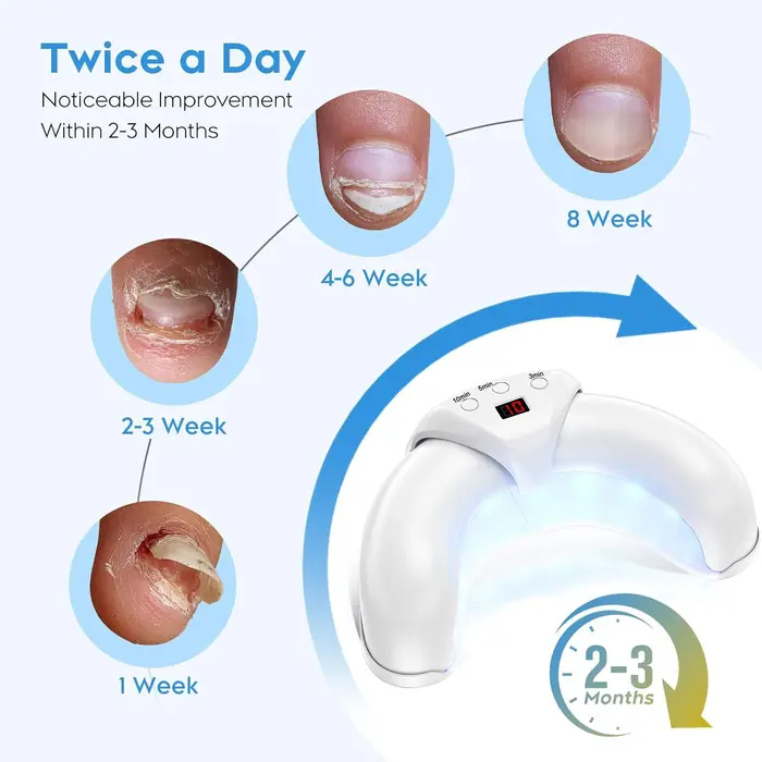 Appareil de traitement laser antifongique pour les ongles, réparation des ongles des mains et des pieds, machine anti-infection pour l'onychomycose, la paronychie et les ongles incarnés