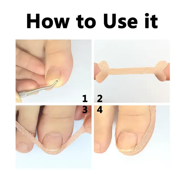 Autocollants de Correction des ongles incarnés