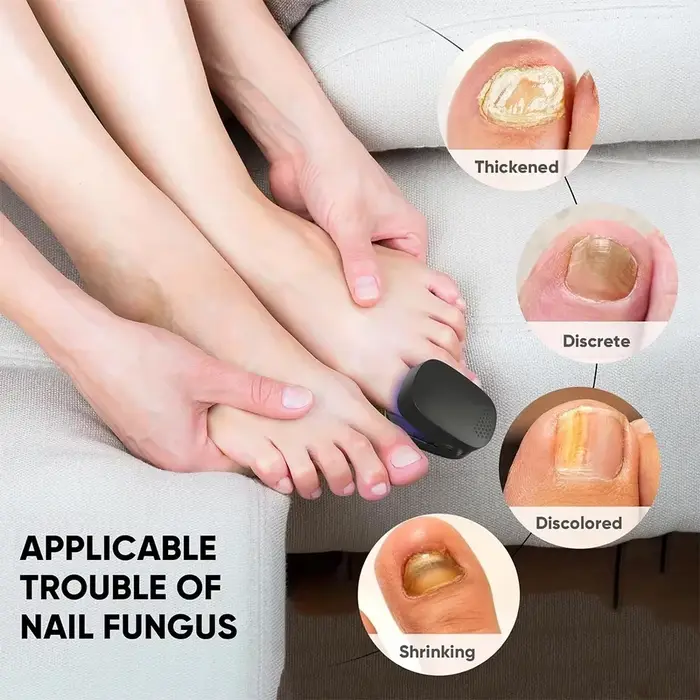 Appareil laser LED pour le traitement des mycoses des ongles