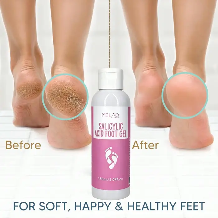 Gel pour les pieds à l'acide salicylique MELAO - Élimine les peaux mortes et les callosités, traitement exfoliant pour les pieds rugueux et gercés, adoucit les talons, 150 ml