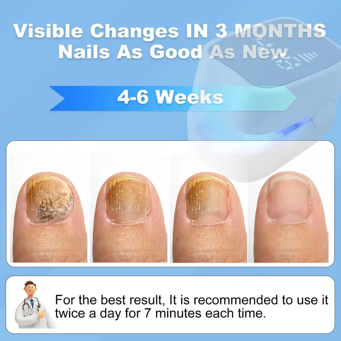Outils de traitement des champignons des ongles à infrarouge, élimine les champignons des ongles des orteils, Infection fongique des ongles, Anti-équipement efficace, Machine Rechargeable