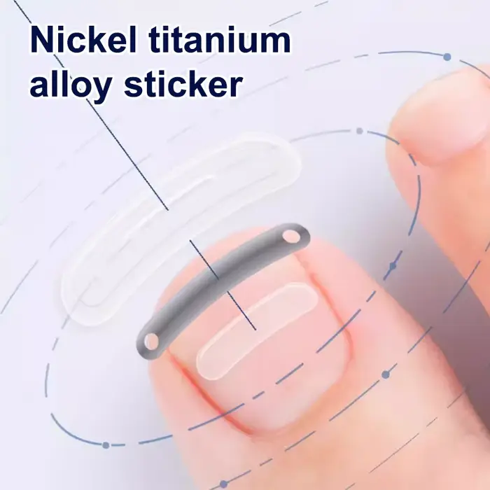 Soins des ongles, Correction des ongles incarnés