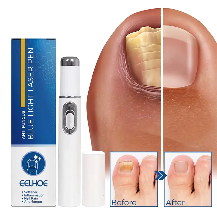 Stylo Laser pour traitement des champignons des ongles