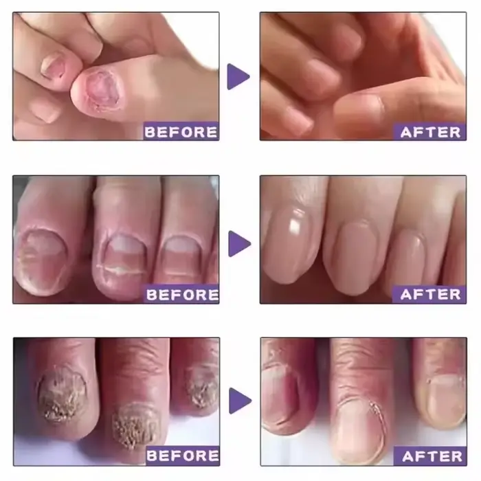 7 jours traitements fongiques des ongles sérum liquide Anti-Infection onychomycose Paronychia soin d