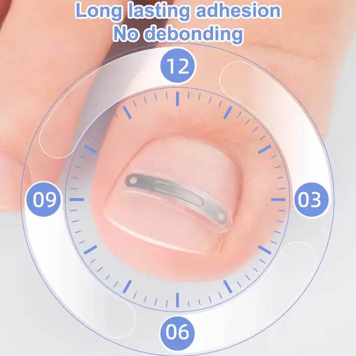 Soins des ongles, Correction des ongles incarnés