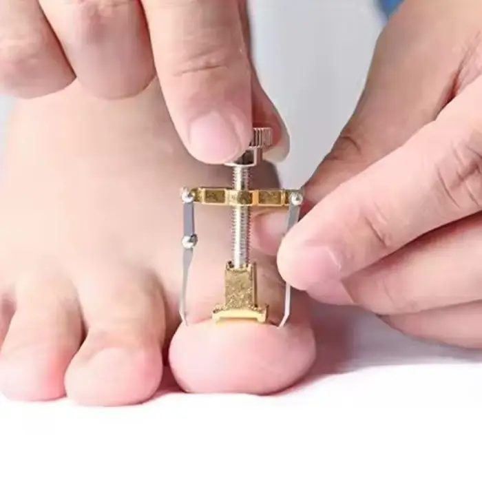 Outil de correction pour ongles incarnés