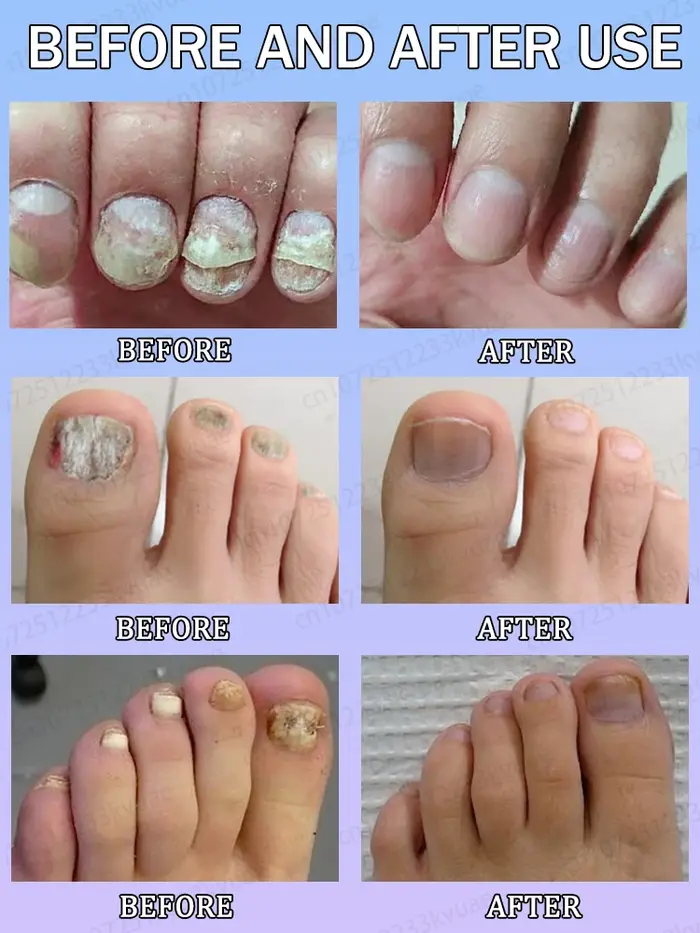 Dites au revoir l'onychomycose et restaurer les ongles normaux
