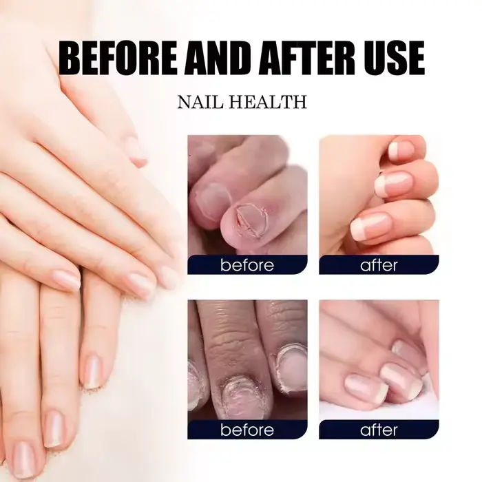 7 jours traitements fongiques des ongles sérum liquide Anti-Infection onychomycose Paronychia soin d