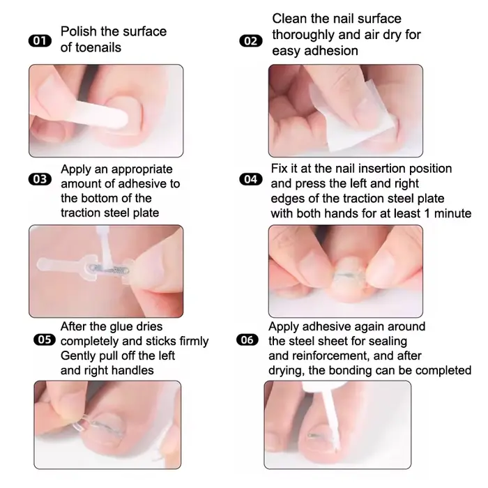 Soins des ongles, Correction des ongles incarnés