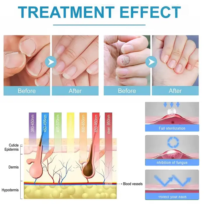 Appareil de traitement au laser pour champignon des ongles