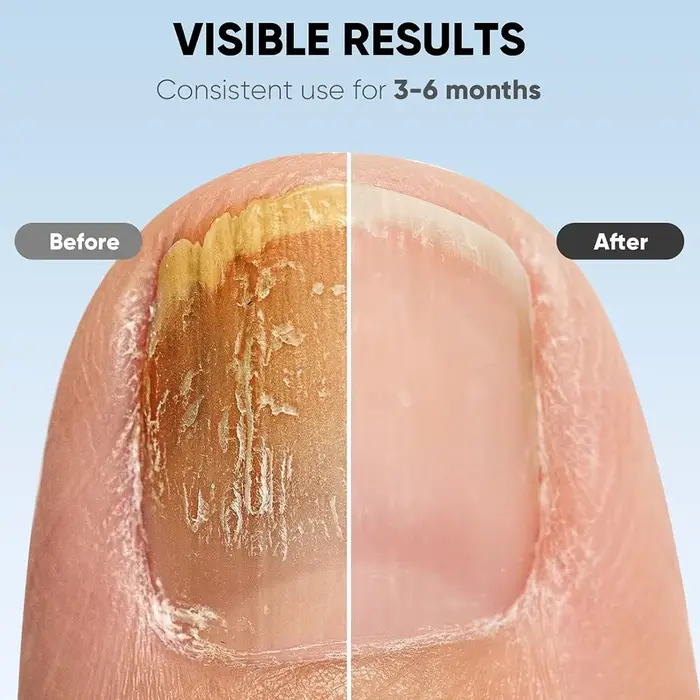 Appareil laser LED pour le traitement des champignons des ongles