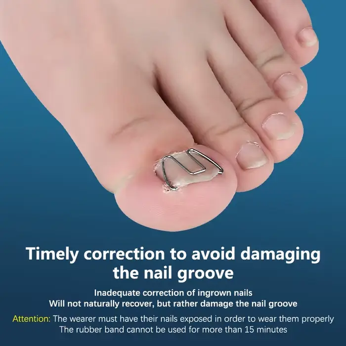 Outil de traitement des ongles incarnés