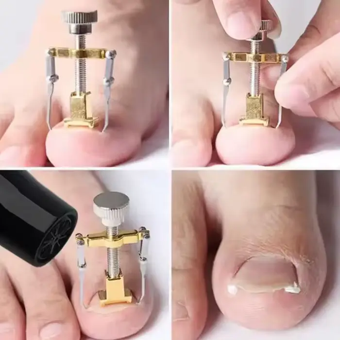 Outil de correction pour ongles incarnés