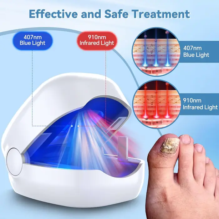 Dispositif Laser fongique pour réparation des ongles des pieds