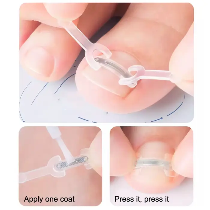 Soins des ongles, Correction des ongles incarnés