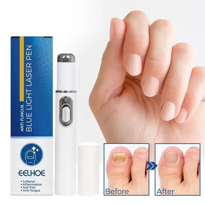 Stylo fongique pour ongles chauds, Anti-champignon, lumière bleue, stylo Laser pour onychomycose, st