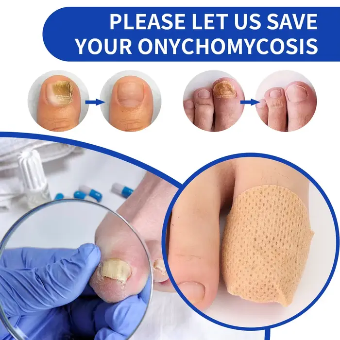 Patch imperméable pour les champignons des ongles incarnés