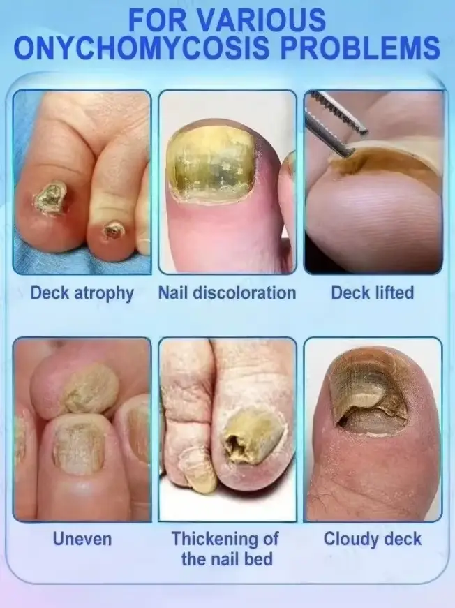 Élimine rapidement les champignons et restaurer les ongles sains 9