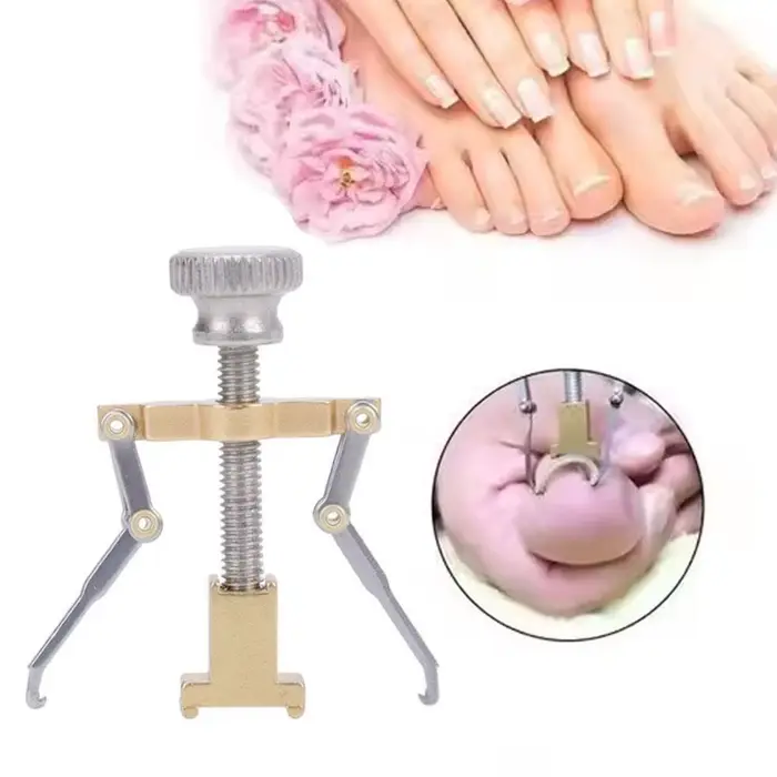 Outil de correction pour ongles incarnés