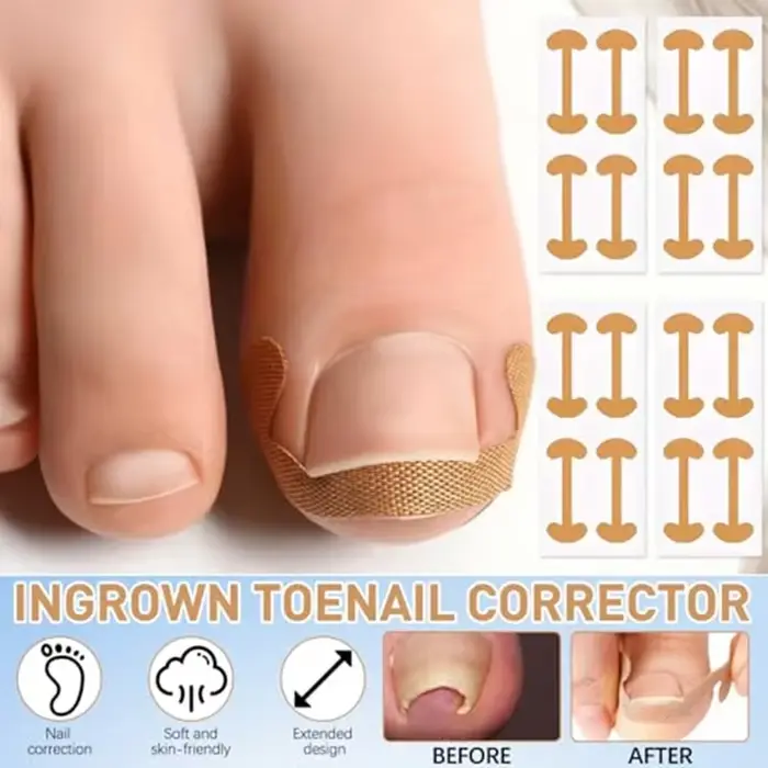 Ensemble de Correction des ongles incarnés