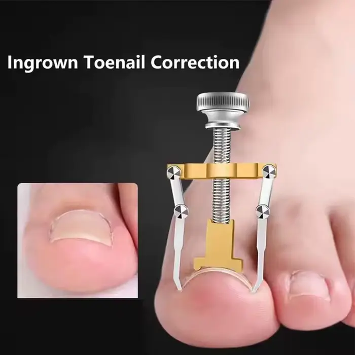 Outil de correction pour ongles incarnés